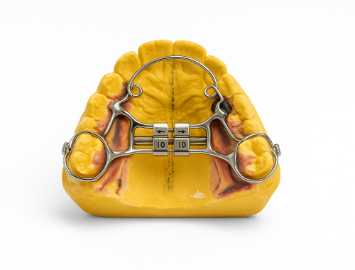 Expansor palatino con tornillo central sobre modelo superior — disyunción rápida del paladar